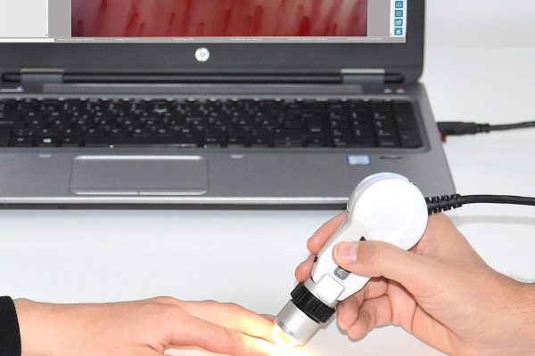 video-Capillaroscopy